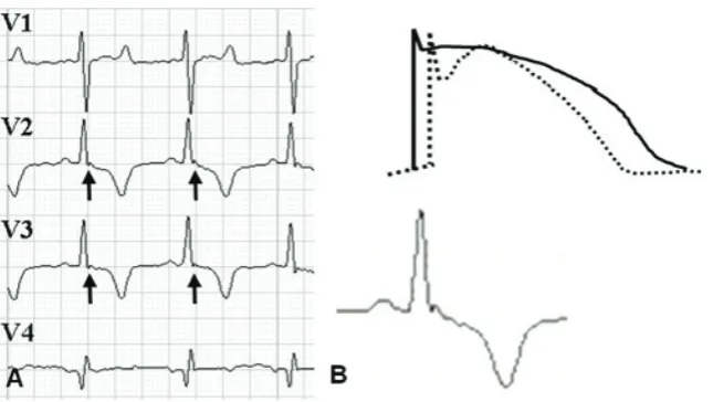 Figure 1. A. Surface ECG of a 12-year-old mongrel dog showing, at the J point (R-S junction), an additional characteristic small wave (black arrows) in the left precordial leads (V1 = CV5RL; V2 = CV6UL; V3 = CV6UL; V4 = V10)