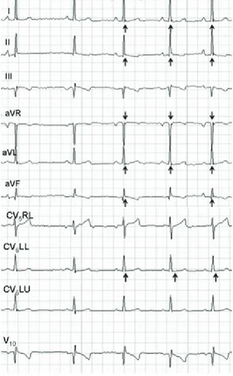 Figure 3. Behaviour of the J wave in an 11 year-old Dachshund with DMVD during submaximal exercise; A = 1 min, B = 2 min, C = 3 min