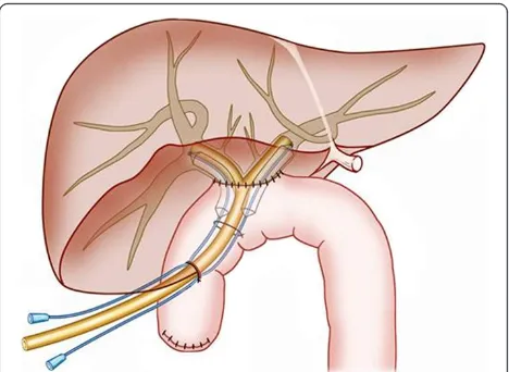 Figure 1 Schematic diagram ofThe balloons passed through the anastomotic stoma with one endin the enteric cavity and the other stretching into the left or rightThe reconstructed hepatic bile duct was sutured with the jejunumby end-to-side anastomosis