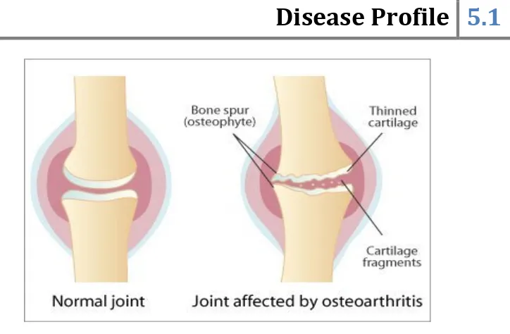 Fig. 5.2: Normal and Osteoarthritis Joint 