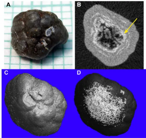 Figure 6Visualization of components of a mixed COM/HA stoneMicro CT slice through middle portion of stone; arrow indi-cates ring of high attenuation (hydroxyapatite)