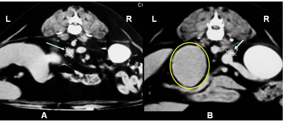 Figure 1. Computed tomography image. A = left adrenal gland (arrow) and B = right adrenal gland (arrow) and the tumour mass (circle) in the left hemi-abdomen; L = left; R = right