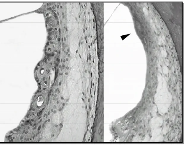 Figure 1-a.  There is thickening of the capillary walls in the stria 
