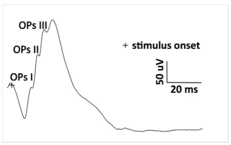 Figure 2. Electroretinogram from a normal five-year-old male dog demonstrates transient, cone-mediated and light-adapted response (stimulus intensity 3 cd·s/m2, background illumination 30 cd/m2)