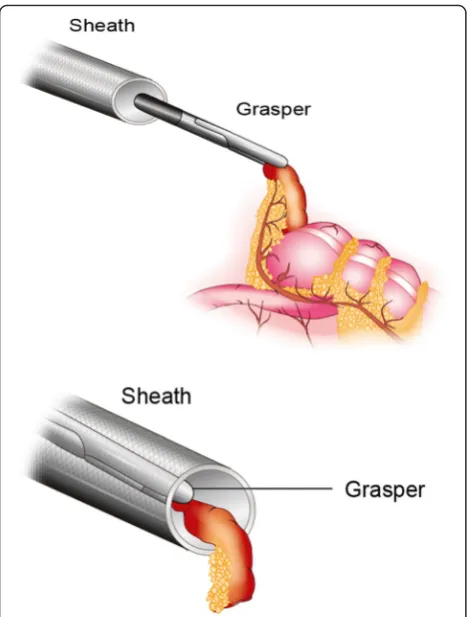 Fig. 1 Picture describing two-trocar laparoscopic appendectomy.The appendix is visualized, grasped, and drawn into the Versa Step™12 mm trocar