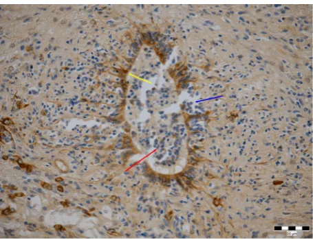 Figure 1. The central canal lined with discontinuous epen- dym, infiltration of subpendymal tissue and ependym by neoplastic cells (blue arrow), invasion of these cells into the lumen of the central canal (red arrow)