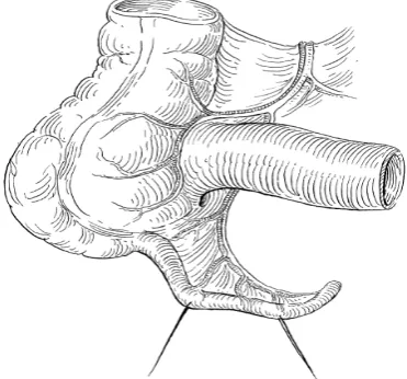 Fig No.1 Artery Supply of Appendix 