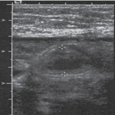 Fig No.3 Ultrasound Finding of Appendix 