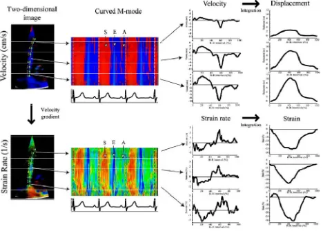 Fig  4:  Data  sets  derived  from  high  frame  rate  2‐dimensional  (2D)  color  Doppler  myocardial velocity can be displayed either as real‐time 2D velocity (top left) or strain rate (SR) (bottom left) image. Regional velocity or SR profiles can also be derived from any selected point in 2D data sets during postprocessing 