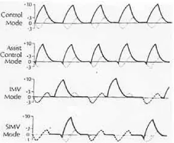 Fig. 1. Airway pressure tracings of the four commonly used volume targeted modes. Thick solid lines represent ventilator breaths; thick dotted lines 