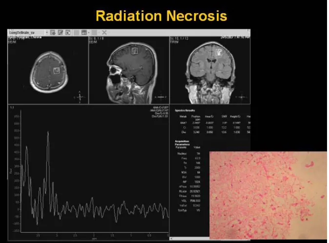 Fig. 3c: MRI after 3 months shows, a small, nodular, peripheral enhancing lesion with perilesional edema in the left frontal cortex 