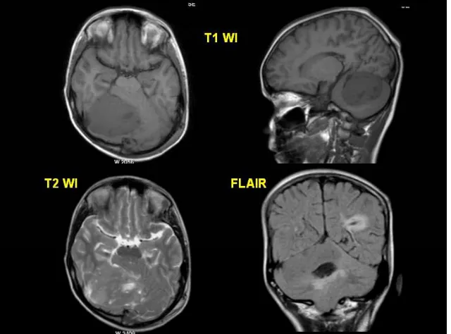 Fig 11b: MRS(TE144) reveals sharp increased Choline height withFig. 11b: MRS(TE144) reveals sharp increased Choline height with Cho/Cr ratio (6.2)with marked reduction of NAA peak;A small inverted peak at 1.4ppm representing alanine.Biopsy : Meningioma 