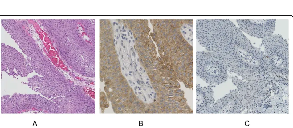 Figure 1 FGFR3 mutation detection on urinary derived DNA. FGFR3 mutation analysis of an FGFR3 tumor without a mutation (A), mutationS249C on tumor DNA (B) and urinary derived DNA (C) from the same patient used in panel B.