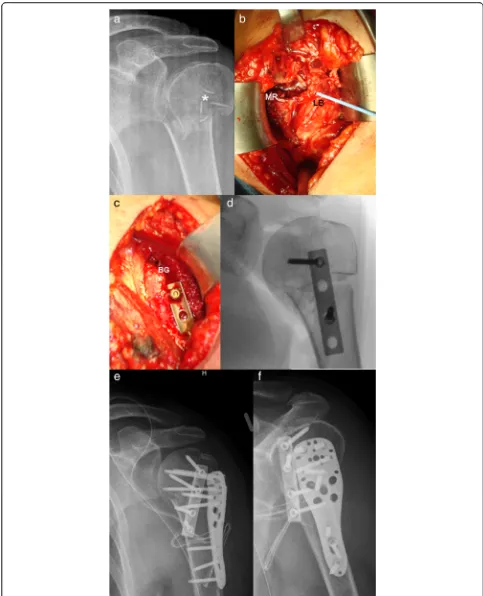 Fig. 2 a a.p. view of a proximal humerus fracture with metaphyseal comminution (*) b intraoperative view showing the comminuted zone; longbiceps tendon with loop (LB), metaphyseal region (MR) c, d the reduction is accomplished with the inverted tubular pla