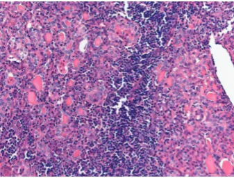 Figure 1: Diﬀuse hyperplasia with prominent uncomplicatedhyperplastic nodes and some lymphocytic thyroiditis (Hematoxy-lin-eosin, ×200).