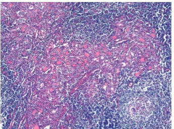 Figure 2: Nodular hyperplasia with degenerative changes, a lim-ited lymphocytic thyroiditis and adipose metaplasia of thyroidstroma