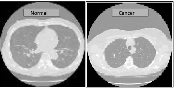 Fig. 1. Typical normal and cancerous LDCT image samples acquired from I-ELCAP  