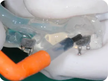 Figure 15 : Application of Resin B (3M unitek) / Part B (relianceorthodontics) to the bracket base