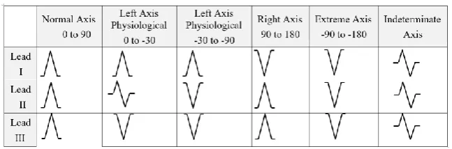 Table 1.  QRS polarity in leads I, II, and III 