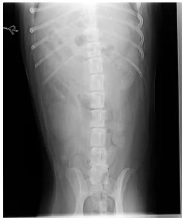 Figure 3. Both ovaries with the uterus including three dissected nodular metastases