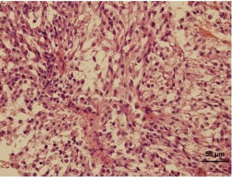 Figure 5. Metastasis in a regional lymph node – the growth is composed of uniform large cells with oval to spheroid-shaped nuclei and a rim of faintly staining cytoplasm