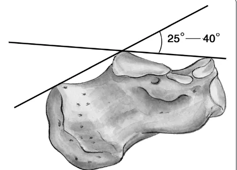 Figure 1 The schematic drawing of the modality ofmeasurement of Böhler’s angle. Böhler’s angle can be measuredwith the use of two intersecting lines: one drawn from anteriorprocess of the calcaneus to the highest part of posterior articularsurface and a second drawn from the same point of posteriorarticular surface to the most superior point of tuberosity.
