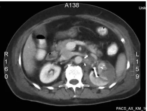 Figure 4CT scan of a patient with bleeding from the tumor bedCT scan of a patient with bleeding from the tumor bed