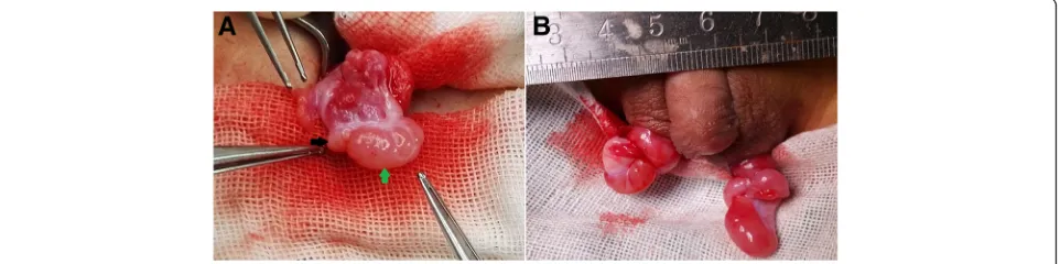 Fig. 4 Intraoperative findings of ovotestes.is soft and pink in a lower pole. There is a distinct line of demarcation between the two portions