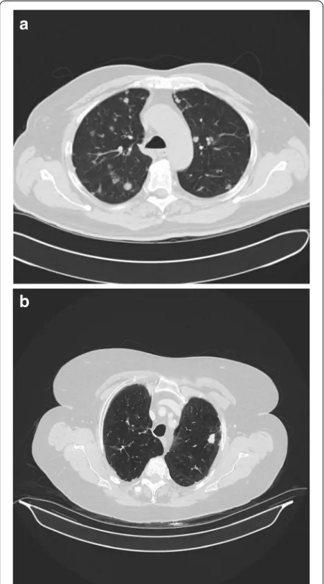 Fig. 2 CT imaging showing cavitating disease initially, whichdeveloped into nodular disease