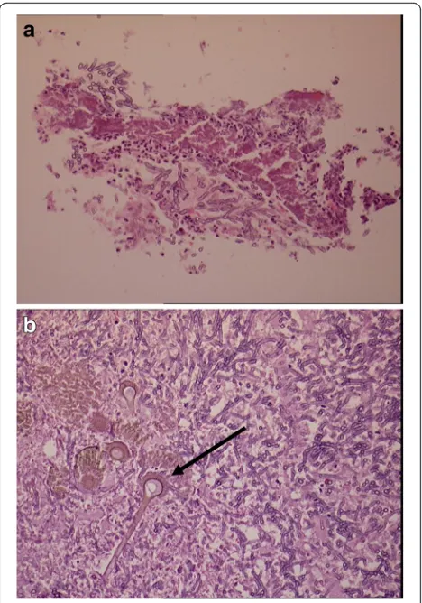 Fig. 3 Biopsy demonstrating inflammation and necrosis and fungalhyphae (low power) and fungal conidia (arrow) on high power