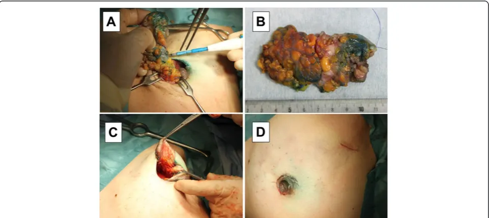 Fig. 2 Surgical procedure of MBD (II). The skin around the wound margin was grasped with sharp towel clamps (a)