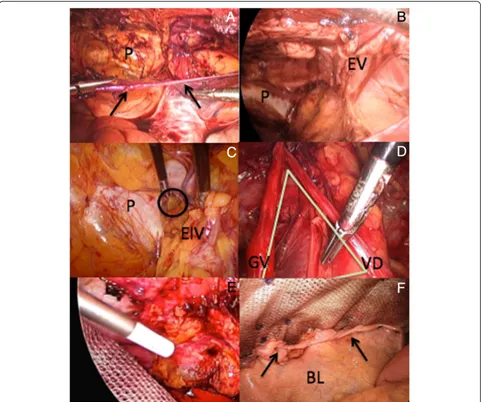Fig. 10 a) Parietal peritoneum (arrows) incised transversally (P: Pubic bone); b) Laparoscopic view of the extraperitoneal space (EV: Epigastricvessels); c) Reduced right femoral hernia (O) medial to the external iliac vein (EIV); d) Left ‘Triangle of Doom’ (VD: Vas deferens, GV: Gonadalvessels); e) Fibrin glue fixation of the infero-lateral aspects of the mesh; f) Closure parietal peritoneum (arrows) over distal part of the mesh(BL: Bladder)
