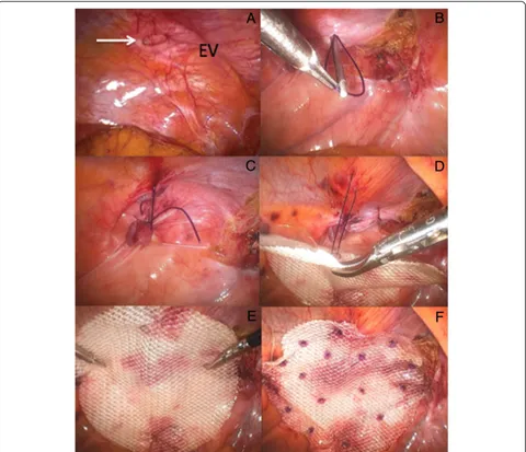 Fig. 13 a2/0 PDS sutures;) Left Spigelian defect (arrow; EV: Epigastric vessels); b, c) Primary closure defect with Endoclose; d, e) Mesh suspension with interrupted f) Polyester mesh secured with absorbable tackers