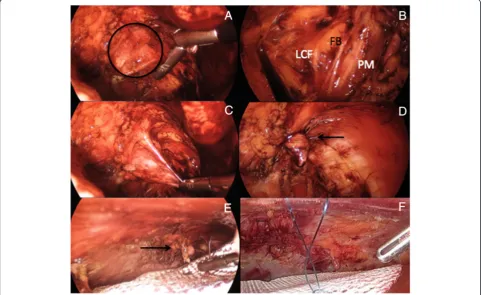 Fig. 14 TEP repair of left Spigelian hernia. a) Abdominal wall defect; b) Left infero-lateral extraperitoneal dissection (LCF: Lateral cutaneous femoralnerve; FB: Femoral branch of the genito-femoral nerve; PM: Psoas muscle); c, d) Inversion and plication of weakened fascia with Endoloop PDS(arrow); e, f) Circular polyester mesh covering plicated (arrow) Spigelian fascia
