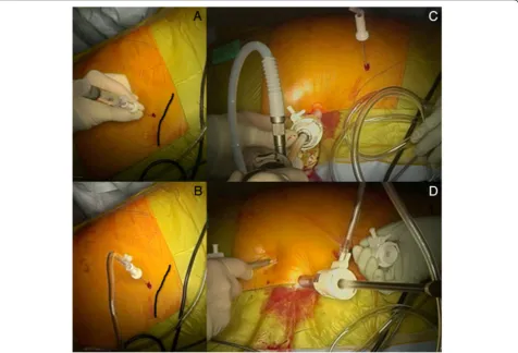 Fig. 1 a) Veress needle insertion at Palmer’s point below the left costal margin; b) 12mmHg pneumoperitoneum; c) First optical trocar at level ofleft anterior axillary line; d) 5mm working ports insertion under direct vision