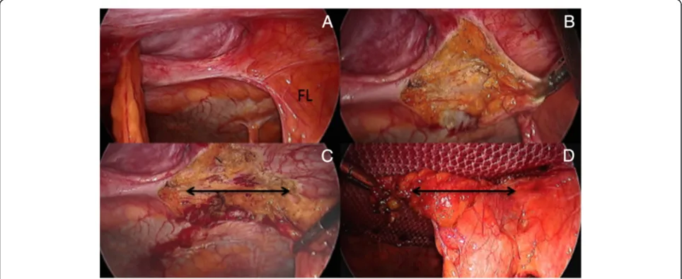 Fig. 2 a) Incarcerated segment of greater omentum in ventral hernia; b) Reduction of hernia sac content; c) Dense adhesions between smallbowel and abdominal wall; d) Sharp dissection between prosthetic material and underlying viscus