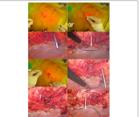 Fig. 4 Transabdominal ‘shoelacing’ technique. a + b) Absorbable PDS suture introduced through stab wound using Endoclose device; c)Laparoscopic view of PDS suture; d) Endoclose reintroduced through same stab incision but using different passageway and grasping end of PDSsuture; e) Loop of PDS exteriorised; f) Same PDS suture reintroduced through abdominal wall using another passageway; g) Final loosefigure-of-eight obtained; h) Second PDS suture