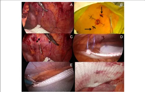 Fig. 7 a) Hydrophilic polyester mesh easily positioned onto abdominal wall; b) Arrows showing absorbable collagen barrier being slightly widerthan its polyester component