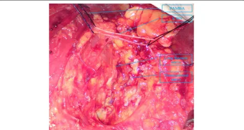 Fig. 2 Part of axillary lymph node dissection. Illustration: Part of axillary lymph node dissection (PALND) is bordered by intercostobrachial nerve(ICBN) on the upper margin, by the long thoracic nerve on the median margin, and by the thoracodorsal nerve o