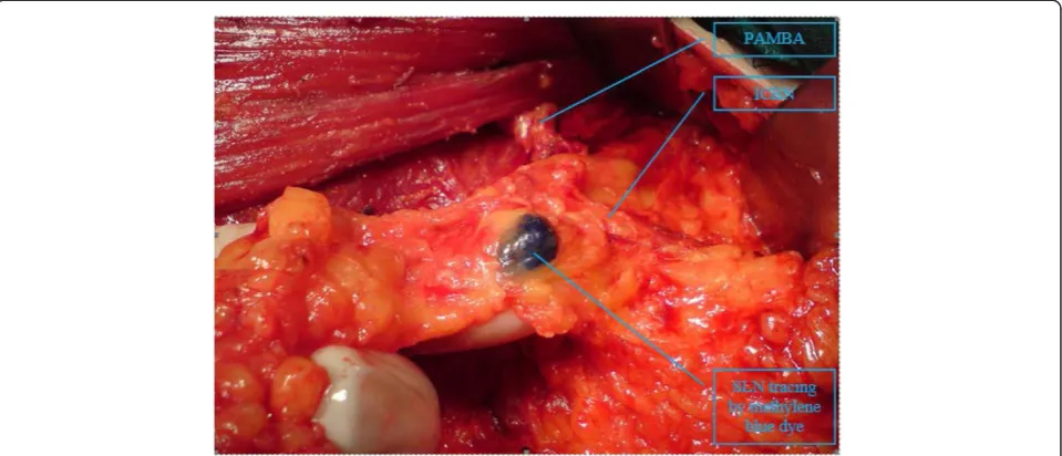 Table 3 Anatomic location of metastatic nodes in patientsunderwent ALND
