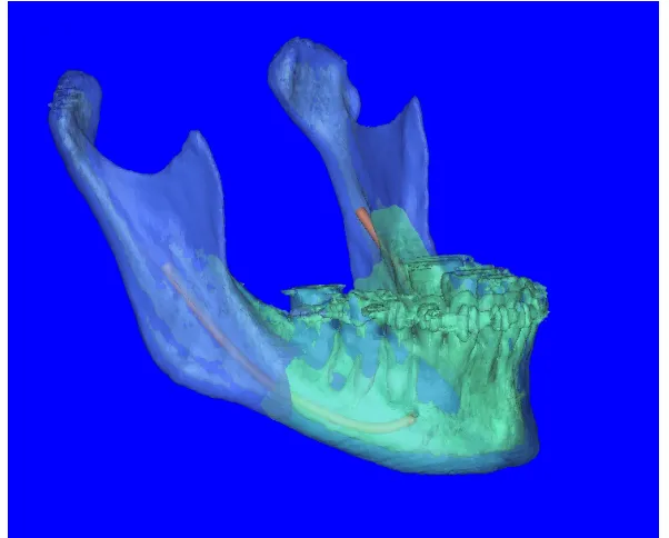 Fig 1: 3D CT image of Reconstructed Mandible 