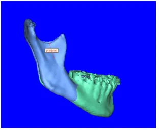 Fig 3:  Sigmoid notch to Antilingula (A on leftside) 