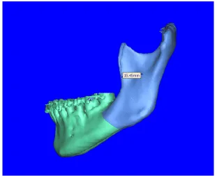 Fig 4:   Antilingula to anterior border of ramus (B on right side) 