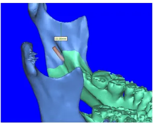 Fig 6:   Sigmoid notch to mandibular foramen (C on right side) 
