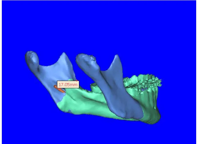 Fig 8:  Mandibular foramen to anterior border of ramus 