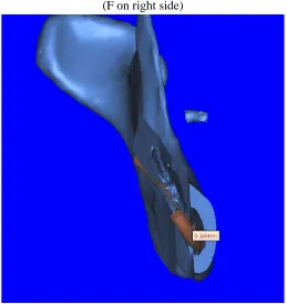 Fig 12: Mandibular canal to buccal plate at second molar 