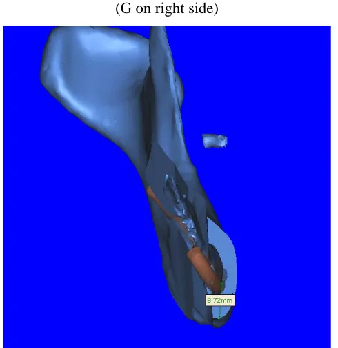 Fig 14: Mandibular canal to lower border at second molar 