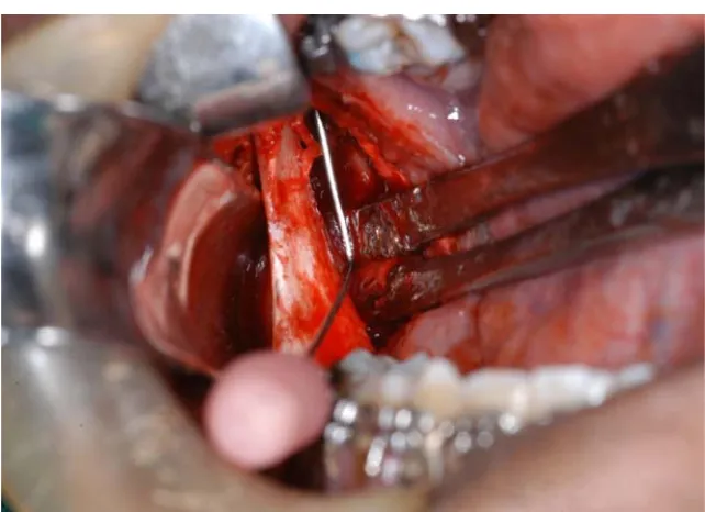 Fig 18:   Mandibular foramen to anterior border (D) 