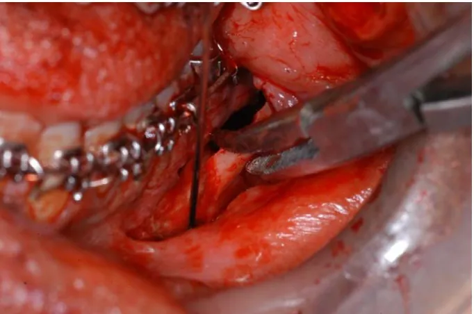 Fig 21:   Mandibular canal to lower border of mandible 