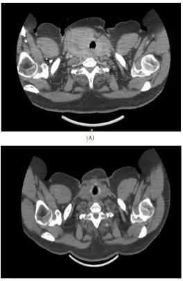 Figure 2. CT scan showing the large goiter of the patient. (A) Prior to surgery; (B) After thyroidectomy